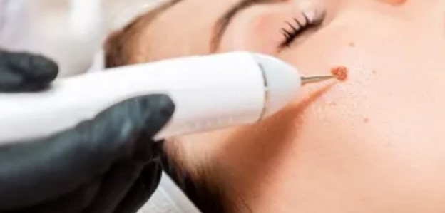 [사마귀없애는법] 얼굴사마귀제거, 눈사마귀제거, 편평사마귀제거