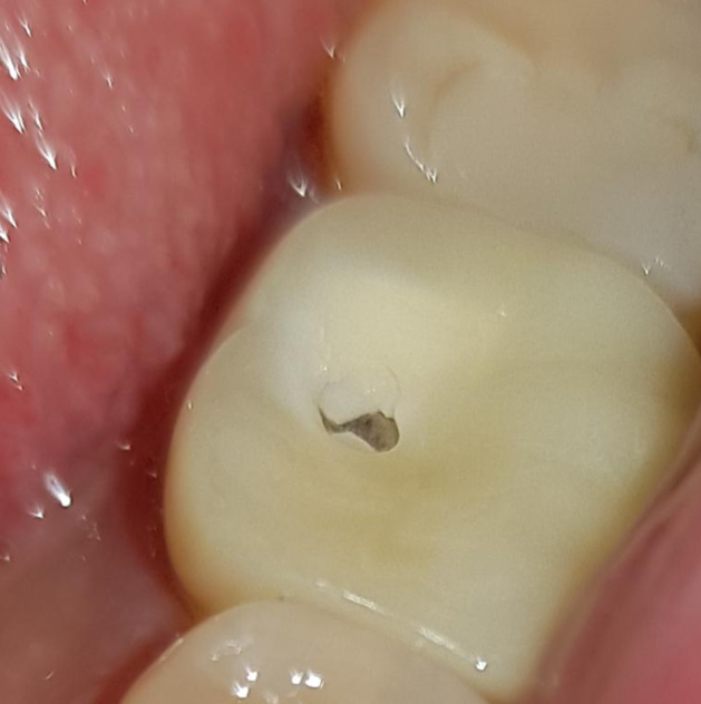 지르코니아-깨짐