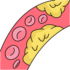 나쁜콜레스테롤 낮추는 방법