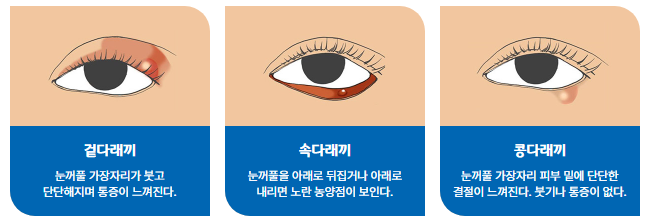 다래끼의 종류