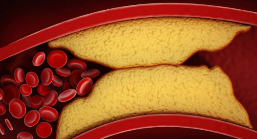 고지혈증 증상&amp;#44; 고지혈증에 좋은 음식&amp;#44; 고지혈증 수치 총정리 (2024ver)