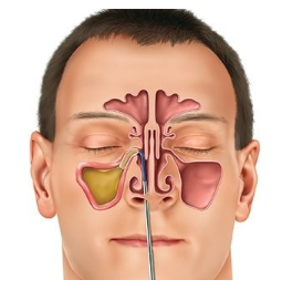 부비동염의 주된 원인