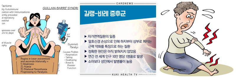 길랑 바레 증후군, 마비 사진