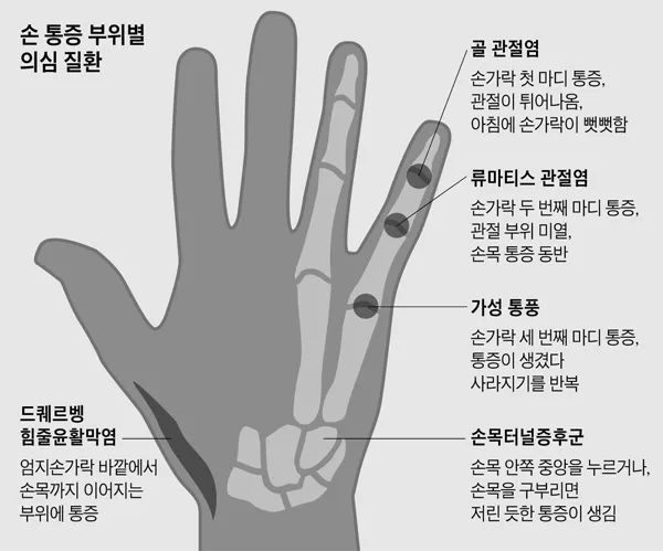 손가락 관절염 증상