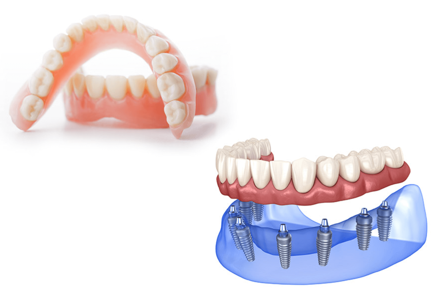 전체임플란트 가격