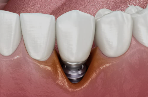 임플란트 가격 확인 최저가 확인 시술기간 (최신)