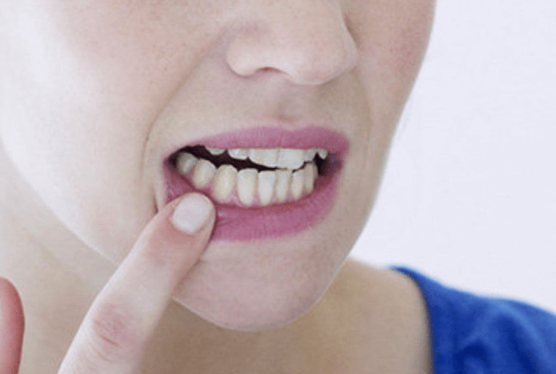 입술 물집 부음