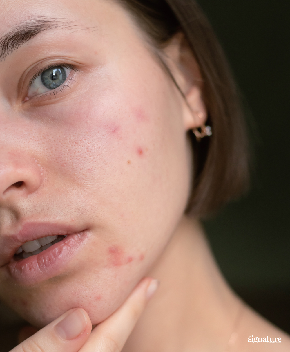 피부유형별복합성여드름특징