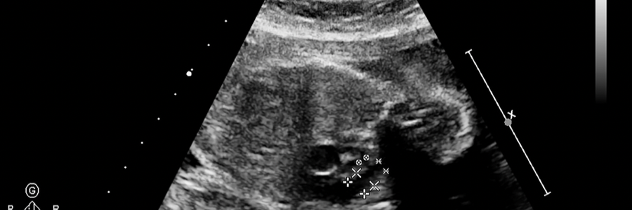 태아_초음파_사진