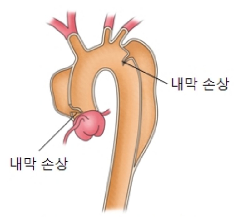 대동맥발리증 증상 대동맥박리
