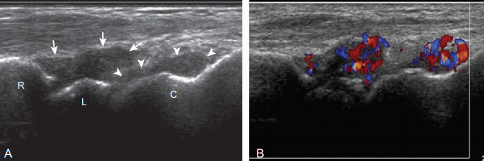 윤활막염(synovitis)