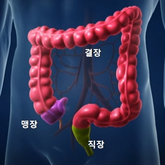 대장암 증상