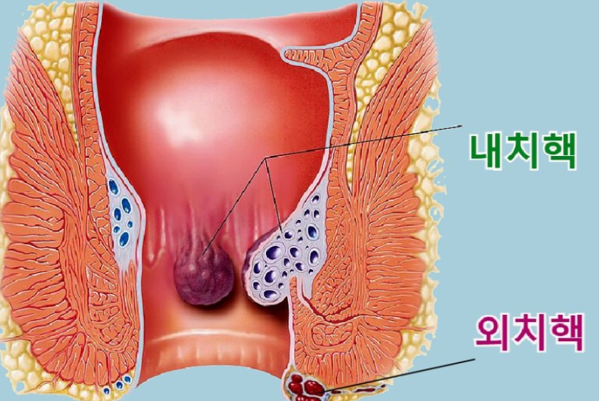 치핵