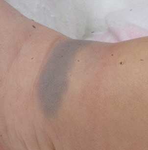 아기 얼굴 몽고반점, 걱정되시죠?