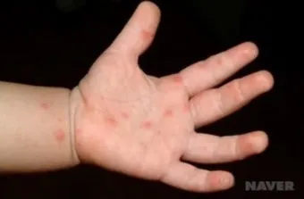 수족구 초기 증상 어른 감염 격리기간 예방 치료 완전 가이드_20