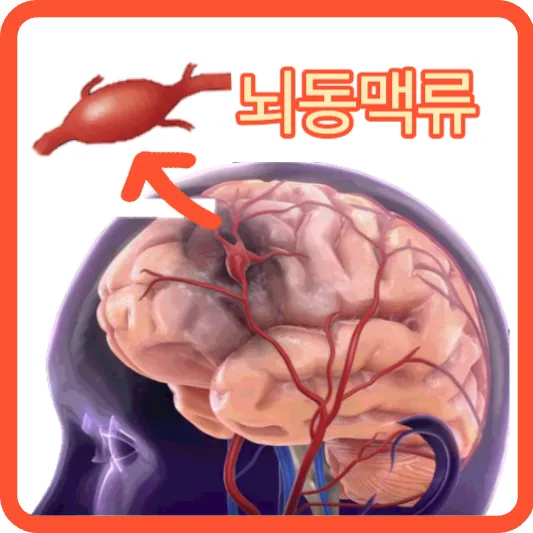 뇌동맥류 원인