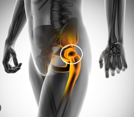 혹시 고관절(股關節,hip joint)을 아시나요?...골절 후 사망률 70%
