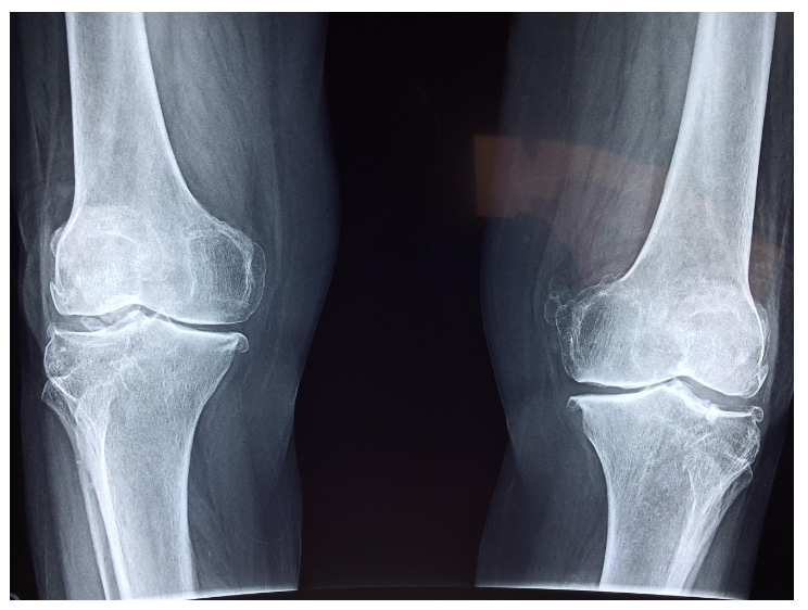 연골손상 — 무릎과 관절이 보내는 경고 신호, 원인부터 회복까지