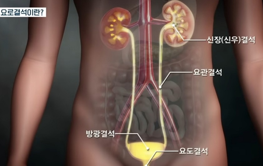EBS명의-요로결석-구교철교수