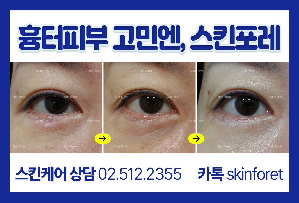 하안검수술 흉터 관리 에스테틱 스킨포레