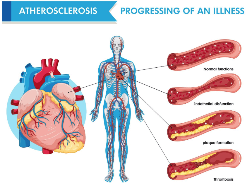 신체에 따라 생긴 혈관 찌꺼기