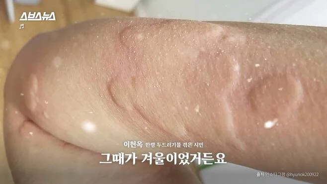 한랭 두드러기 증상 예시(출처-스브스뉴스)