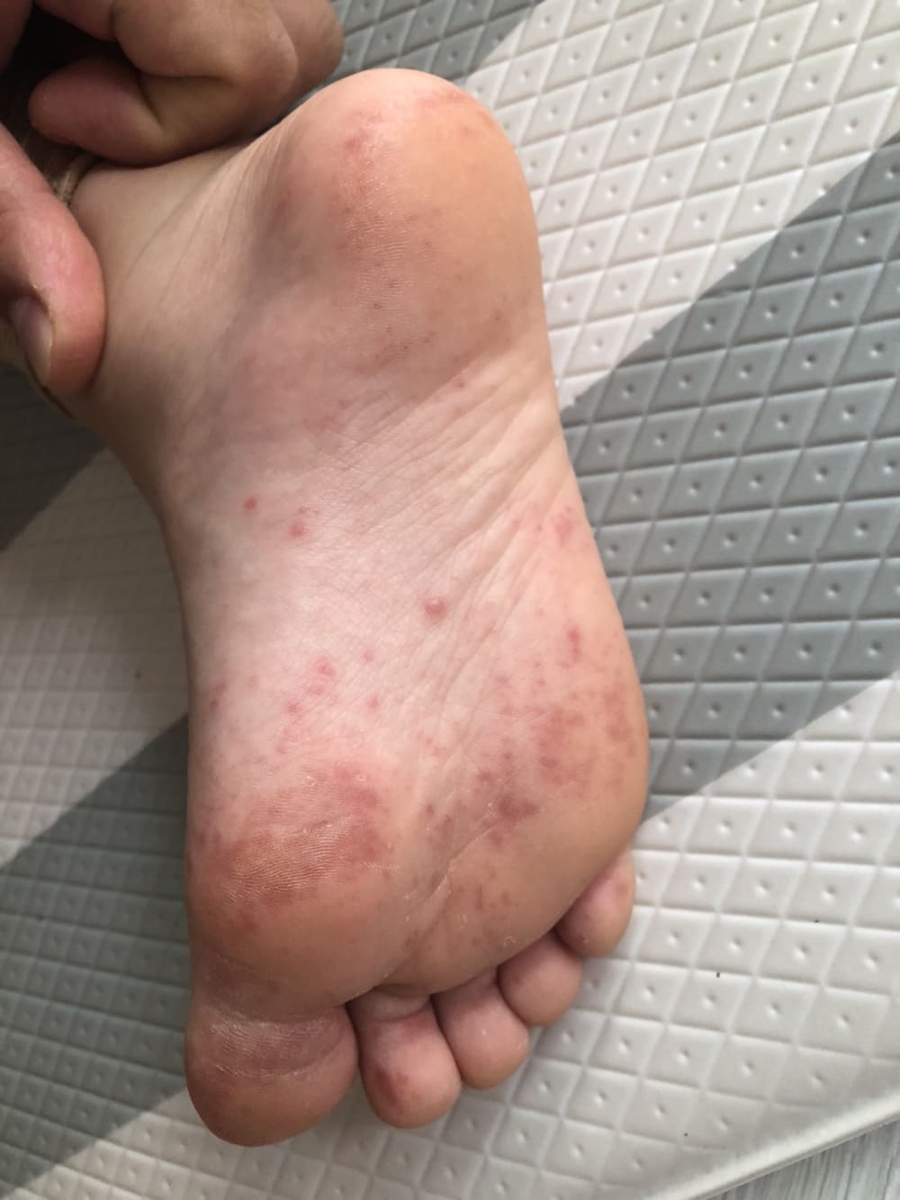 첫째아이 오른발붉은발진