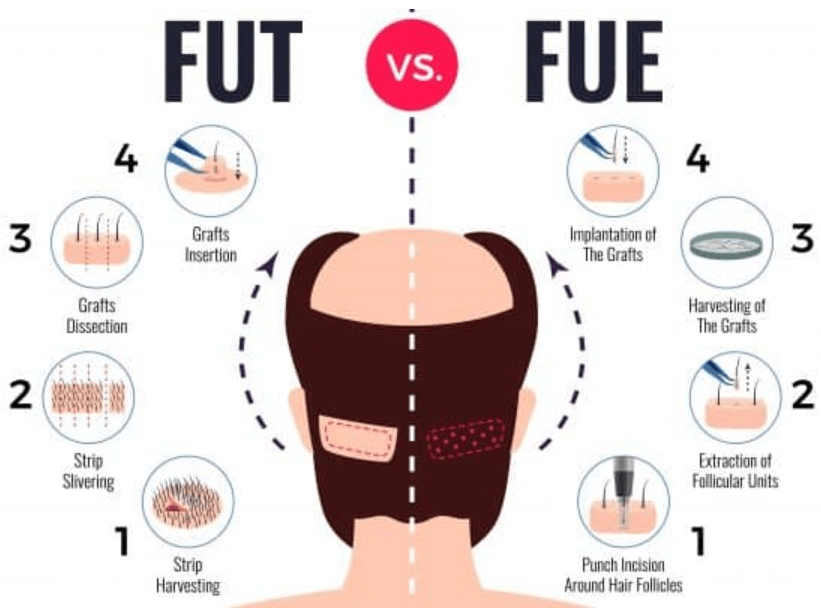 모발이식 3000모 비용
