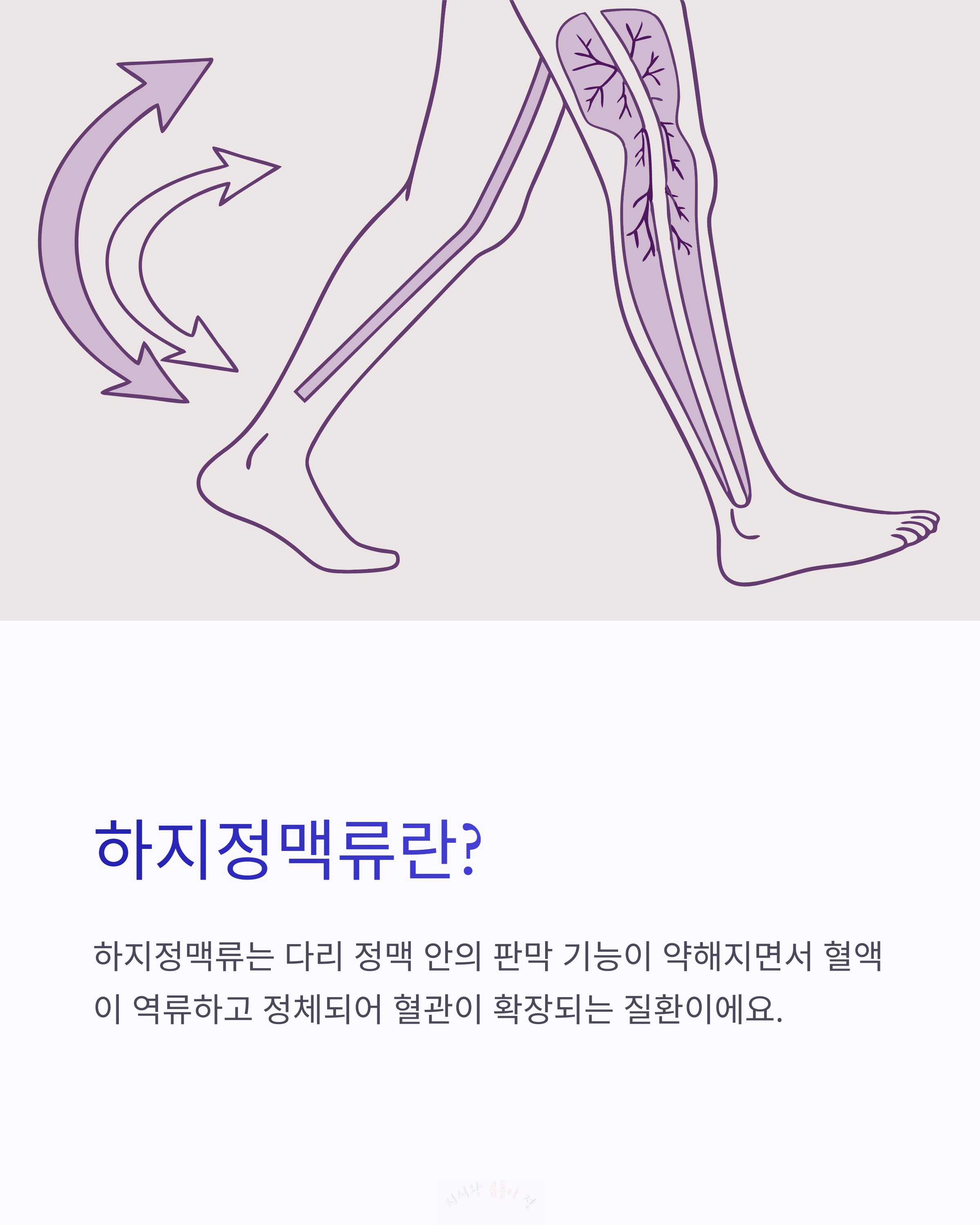 하지정맥류란?