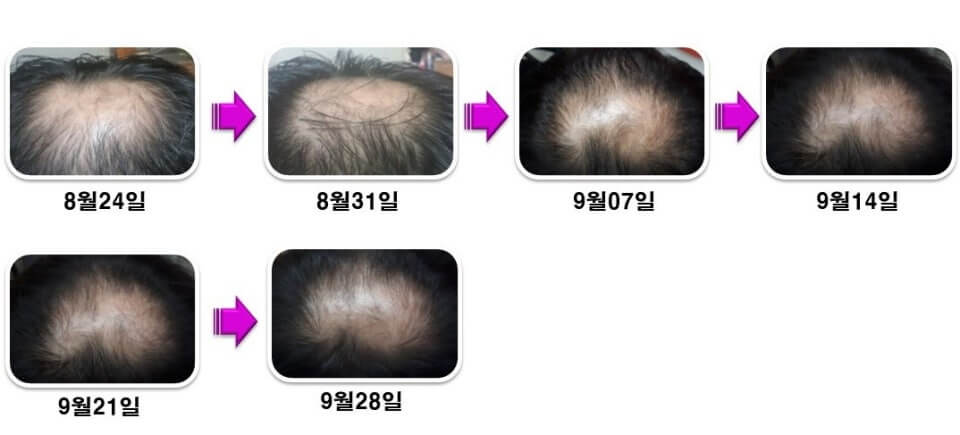 대전 늘푸른의원 탈모 치료, 탈모샴푸 그래비티