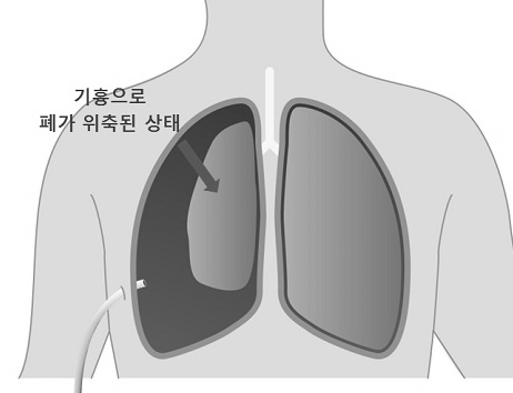 폐기흉 증상 뜻 원인 수술 비용 치료 호흡 곤란 예방법 총정리
