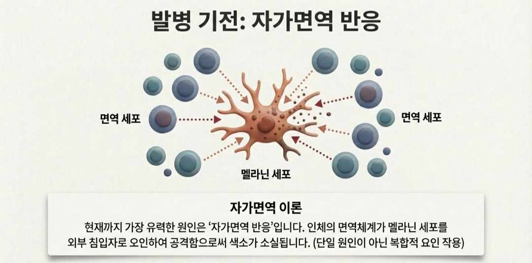 백반증원인-사진9