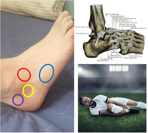 발목이 아플 때