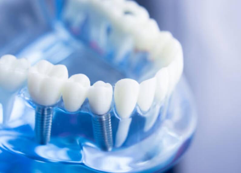 임플란트 가격비교