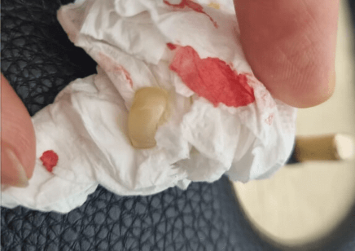 지르코니아 깨짐