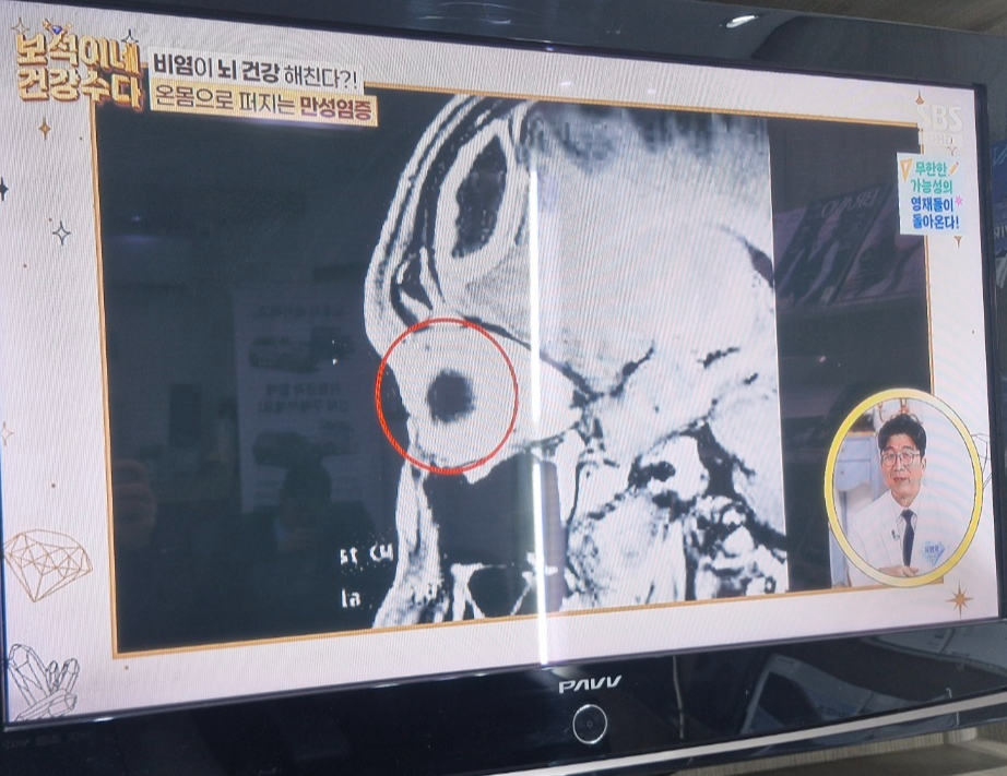 남편+아내의 코골이가 질병의 신호?(비염 방치하면 페농양+부비동염+뇌수막염 위험성 30%이상 높아진다.)