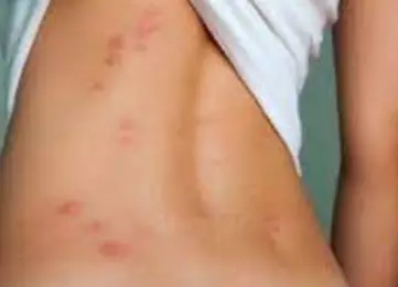 대상포진-초기증상-원인-건강