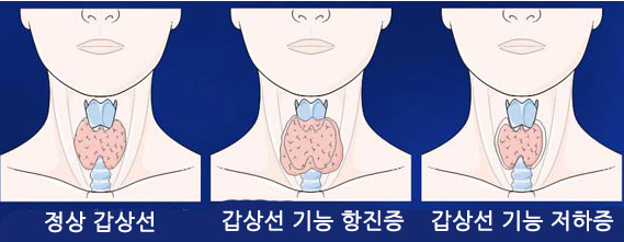 갑상선 기능 항진증, 눈 건강에도 영향을 미칠까?
