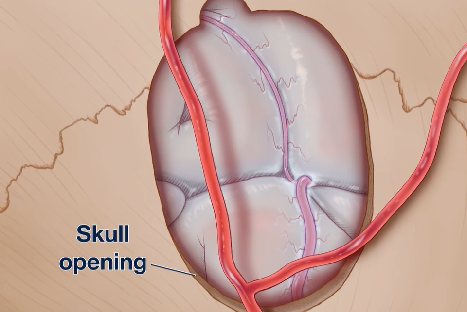 모야모야병 증상