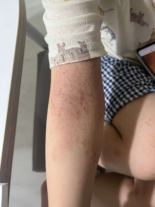 보건소 아토피사업 신청방법 