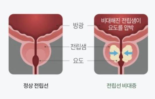 카리토-포텐-전립선비대증