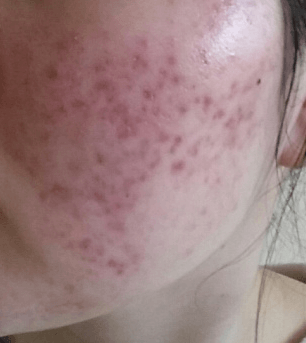 민감성 피부 체크 방법