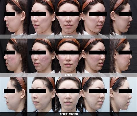 대구 눈밑필러