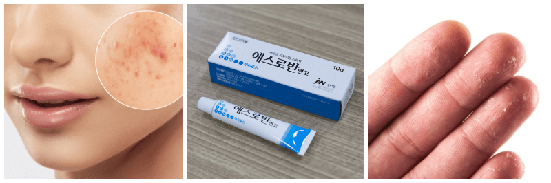 여드름, 에스로반 연고, 습진 사진