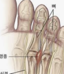 발가락 통증