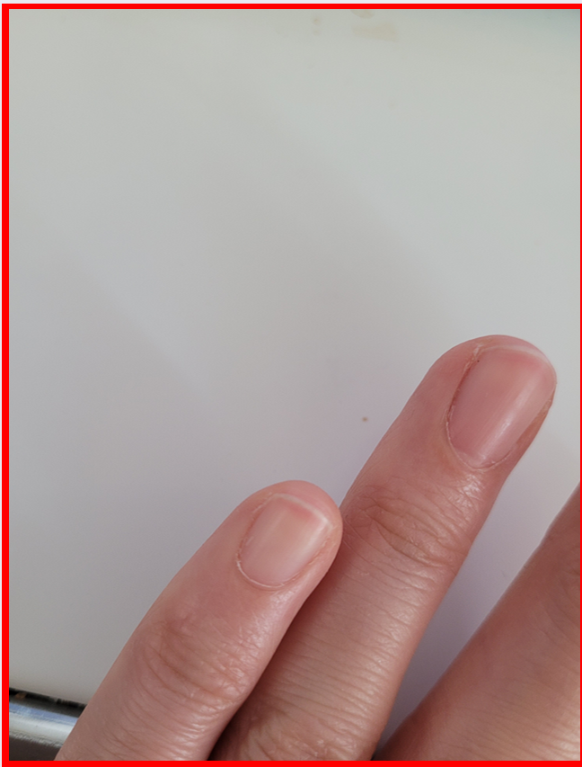 알부민 섭취 후 단단해진 손톱