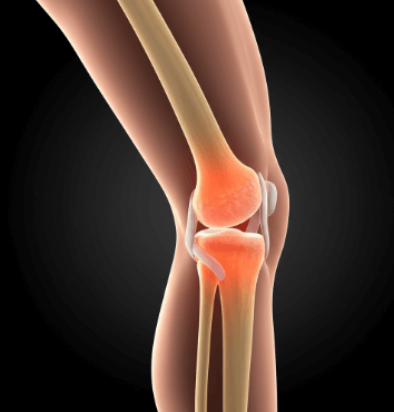 퇴행성관절염 증상 총정리17