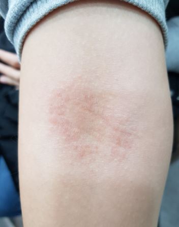 팔꿈치-안쪽-접촉성-피부염