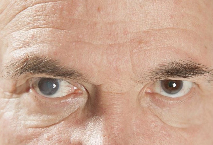 노안 백내장 종류