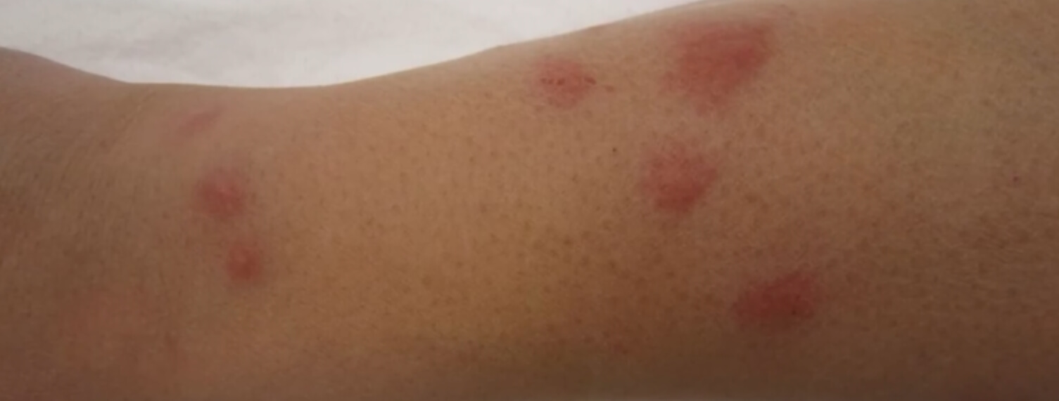 빈대 물렸을 때